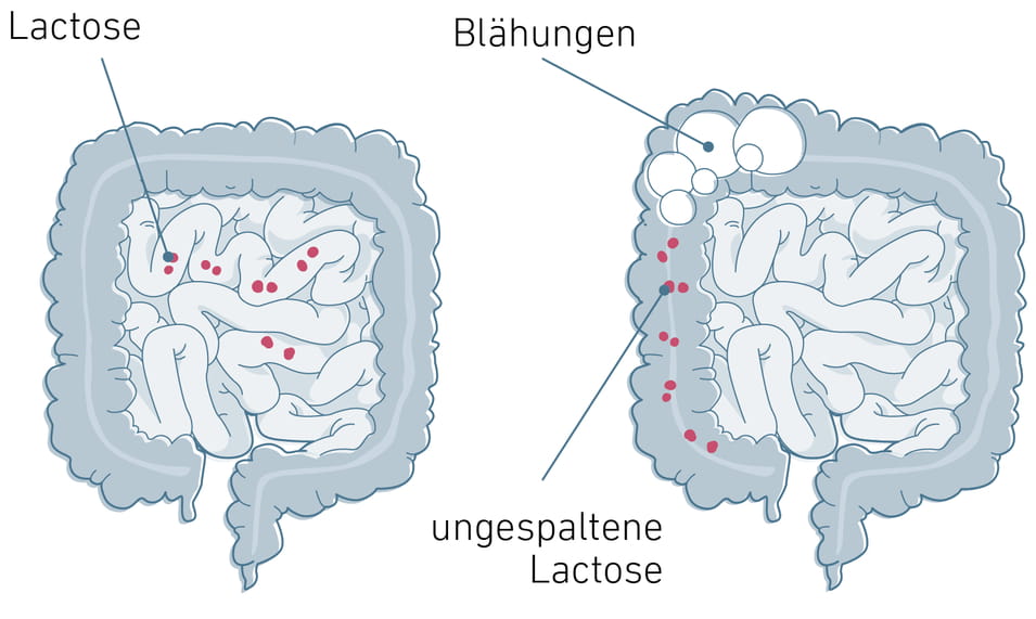 Laktoseintoleranz